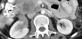 Lymphoma