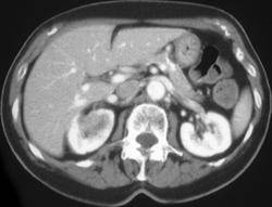 MetastasisRtKidney