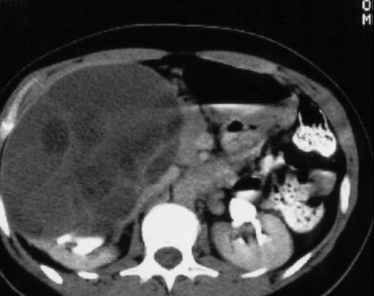 Multilocularcyst nephroma
