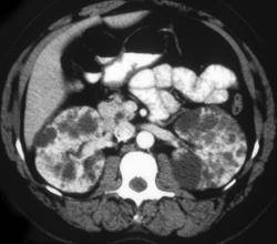 PolycysticKidneys