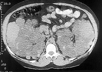 PolycysticScontrast