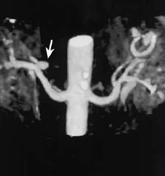 RenalArtAneurysm