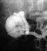 RenalArtAneurysm2