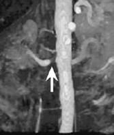 RenalArtStenosis