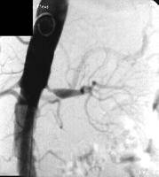 RenalArtStenosis1