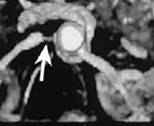 RenalArteryStenosis