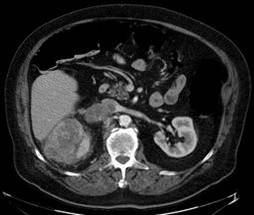 RenalVThrombosis