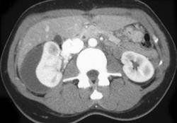 SubcapsularHematoma