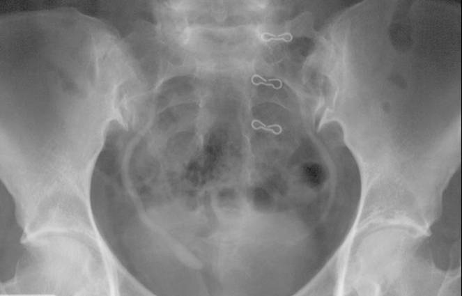 Ureterocele