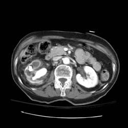 XanthogranulomatousPyelo