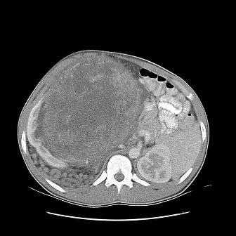 angiomyolipoma