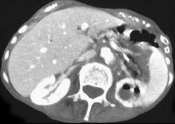 emphysematous pyelo