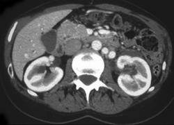 enlarged l renal vein