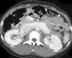 enlargedleftrenalvein
