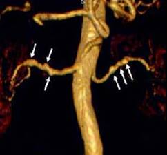 fibromusculardysplasia