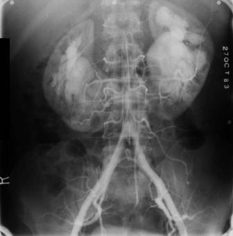 horseshoekidney
