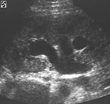 hydronephrosis US
