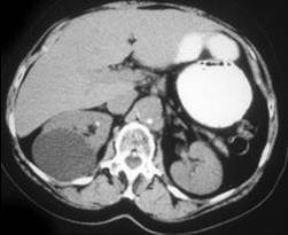 kidney cyst1