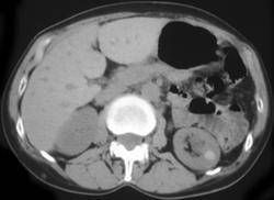 kidneycyst2