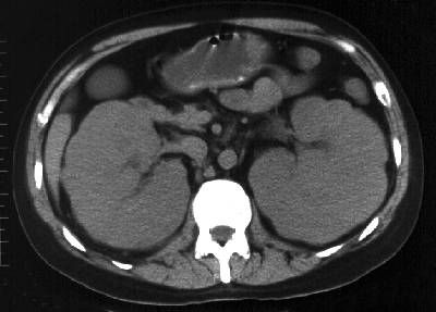 lymphoma kidney