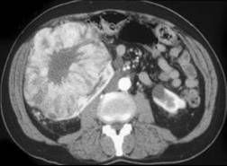 oncocytoma