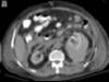 perinephric hematoma