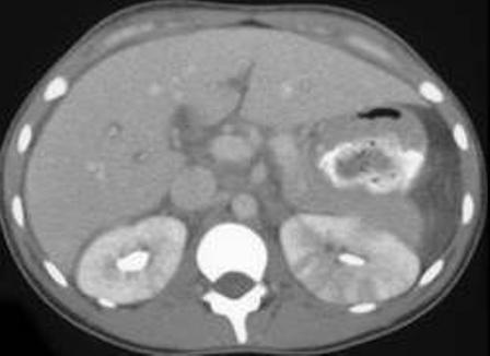 pyelonephritis