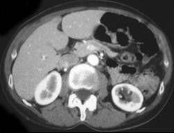renalcyst contrast