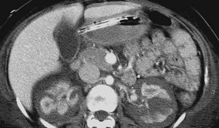 renalinfarcts sicklecell
