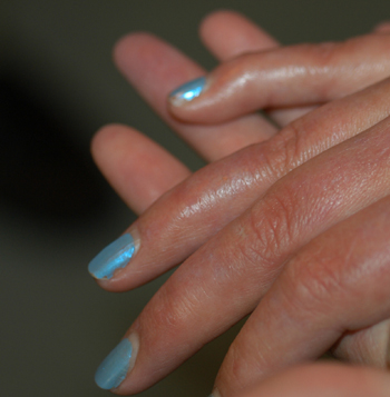 scleroderma2