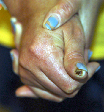 scleroderma3