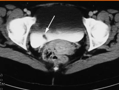 ureteralpolyp